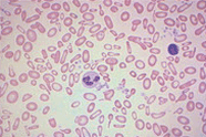 : : :  hipocromia, anisocitose e poiquilocitose  : : :
